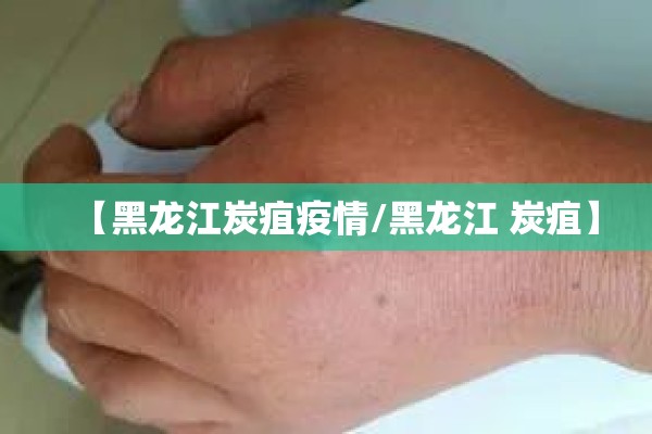 【黑龙江炭疽疫情/黑龙江 炭疽】