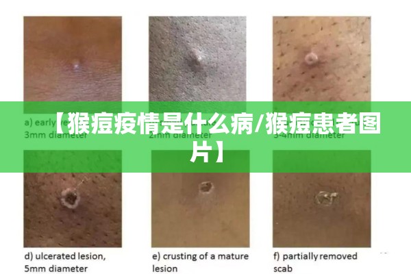 【猴痘疫情是什么病/猴痘患者图片】