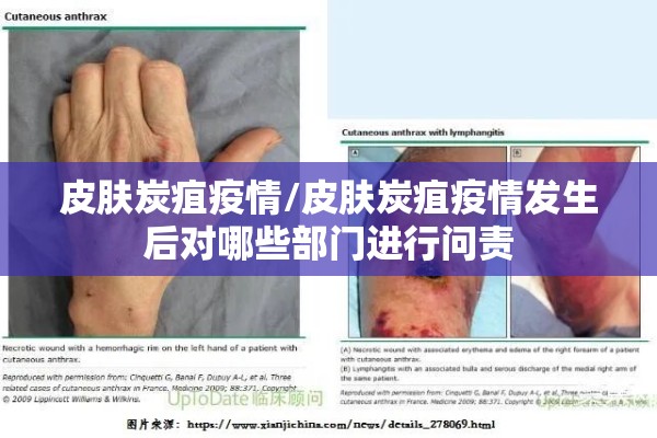 皮肤炭疽疫情/皮肤炭疽疫情发生后对哪些部门进行问责