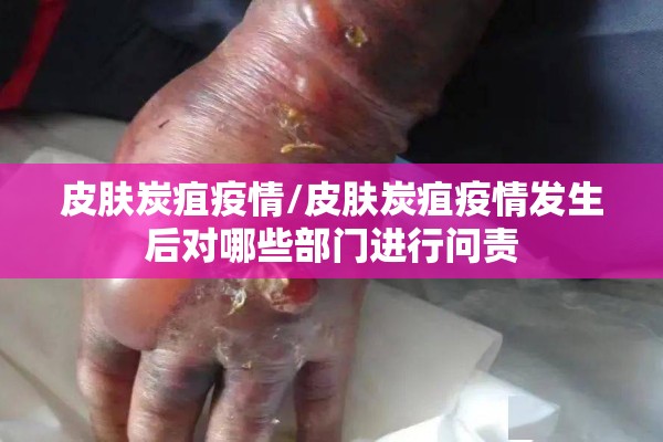 皮肤炭疽疫情/皮肤炭疽疫情发生后对哪些部门进行问责