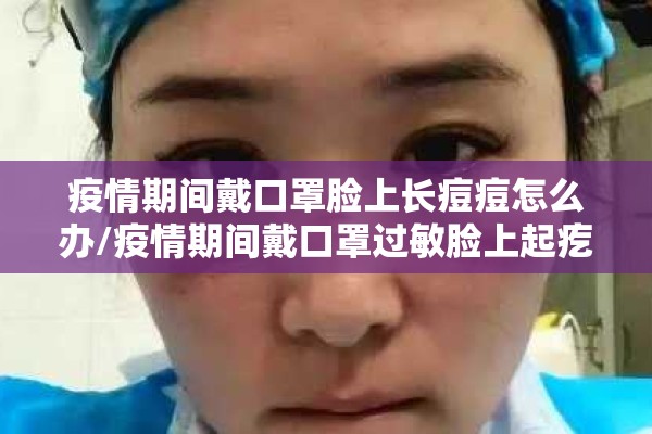 疫情期间戴口罩脸上长痘痘怎么办/疫情期间戴口罩过敏脸上起疙瘩