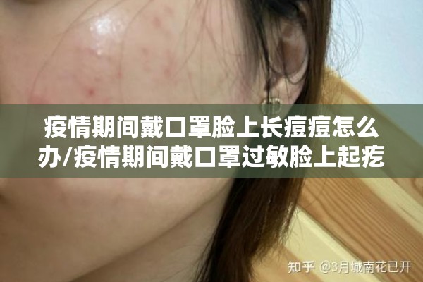 疫情期间戴口罩脸上长痘痘怎么办/疫情期间戴口罩过敏脸上起疙瘩